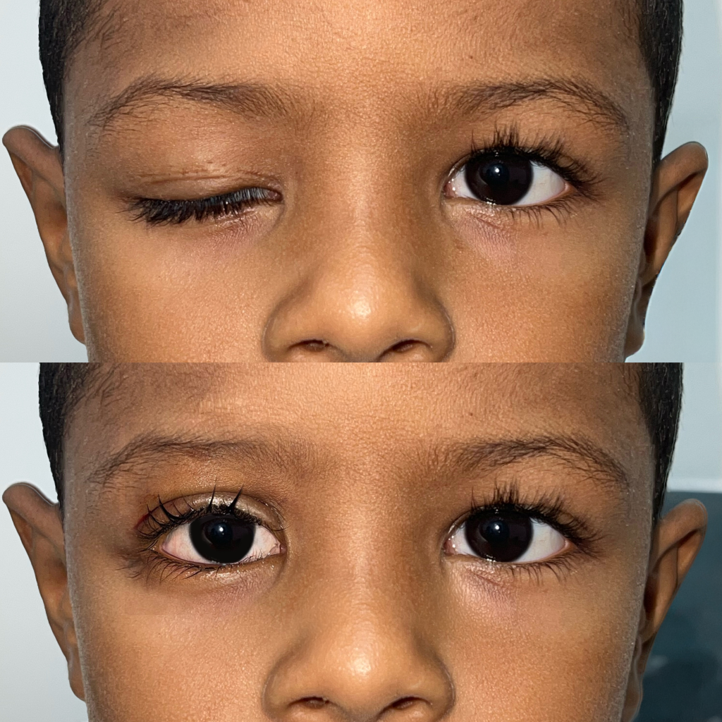 Ptosis Parpebral Infantil